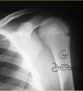 http://drepanosite.free.fr/imagerie%20complications%20drepanocytose%20sauf%20AVC_fichiers/image013.jpg